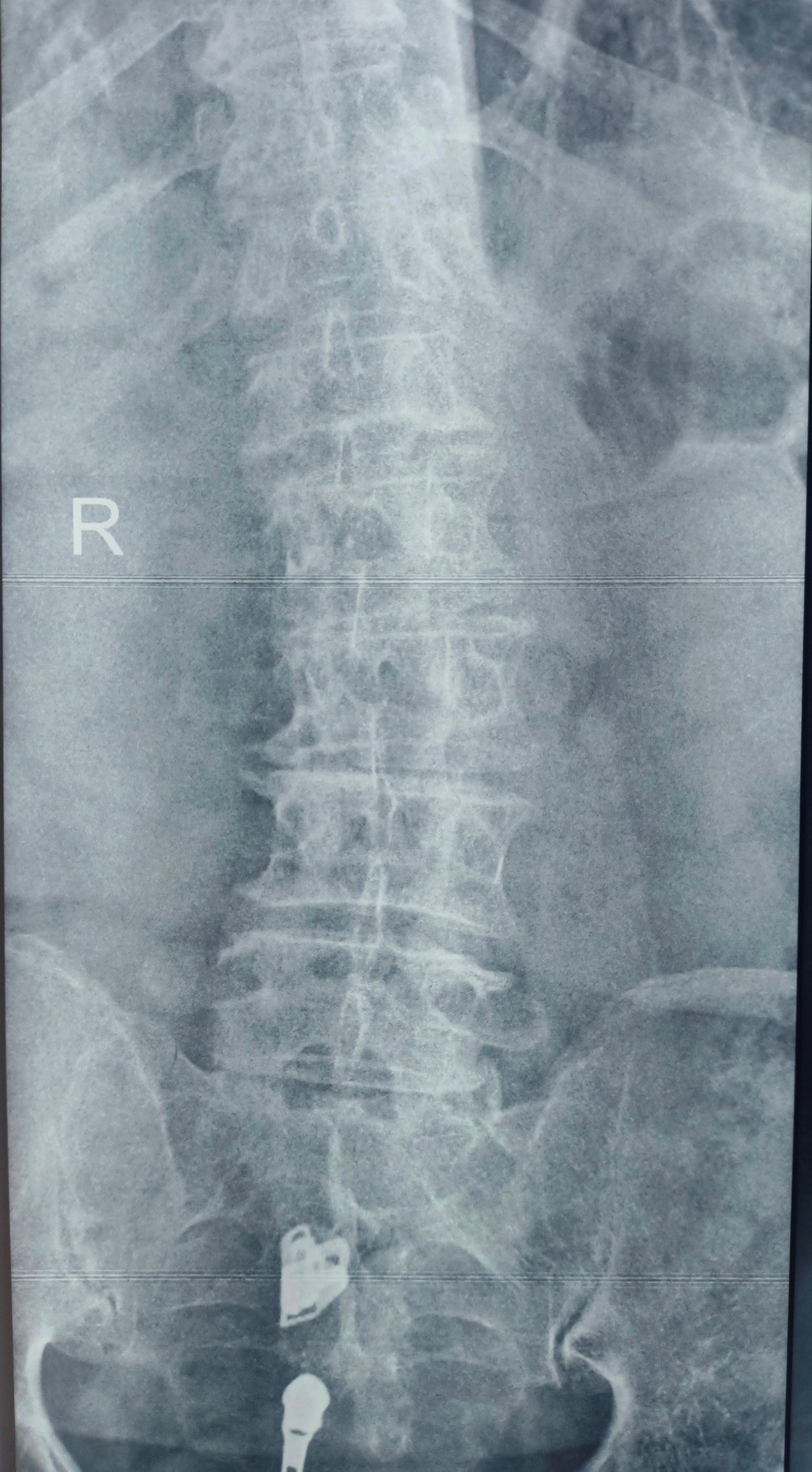 High-Grade Lumbar Spondylolisthesis with Severe Stenosis