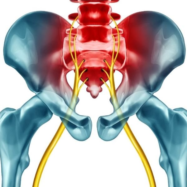 Sciatica / Lumbar Disc Prolapse