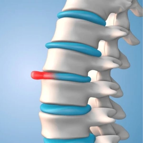 Understanding Slip Disc